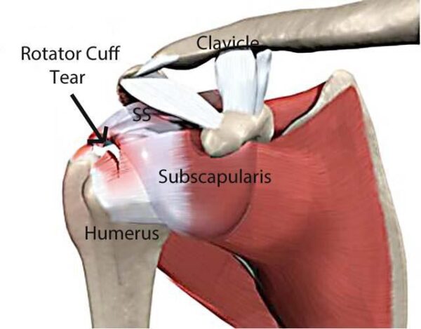 When is Surgery Necessary for Rotator Cuff Pain? Insights From Dallas Shoulder Specialists